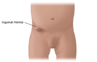 pic2_inguinal_hernia