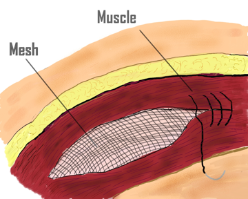 Open incisional hernia repair